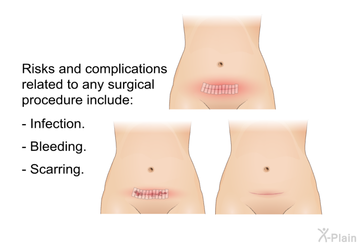 Risks and complications related to any surgical procedure include:  Infection. Bleeding. Scarring.