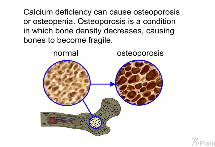 Calcium deficiency can cause osteoporosis or osteopenia. Osteoporosis is a condition in which bone density decreases, causing bones to become fragile.