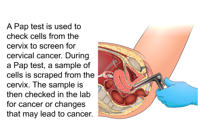 A Pap test is used to check cells from the cervix to screen for cervical cancer. During a Pap test, a sample of cells is scraped from the cervix. The sample is then checked in the lab for cancer or changes that may lead to cancer.