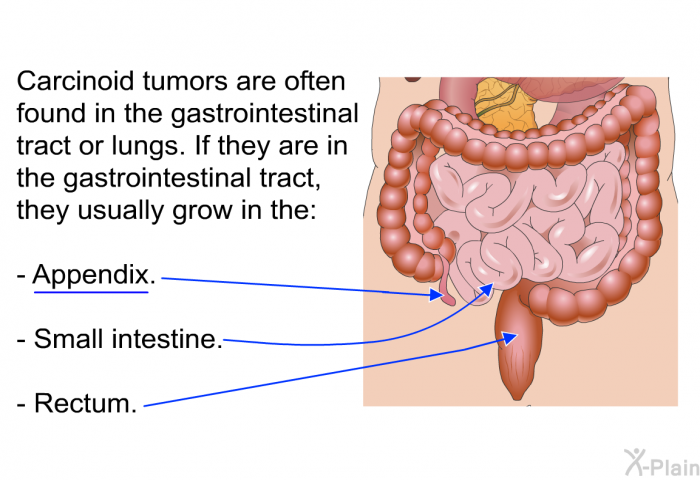 Carcinoid tumors are often found in the gastrointestinal tract or lungs. If they are in the gastrointestinal tract, they usually grow in the:  Appendix. Small intestine. Rectum.