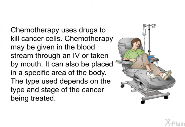 Chemotherapy uses drugs to kill cancer cells. Chemotherapy may be given in the blood stream through an IV or taken by mouth. It can also be placed in a specific area of the body. The type used depends on the type and stage of the cancer being treated.