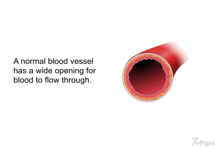 A normal blood vessel has a wide opening for blood to flow through.