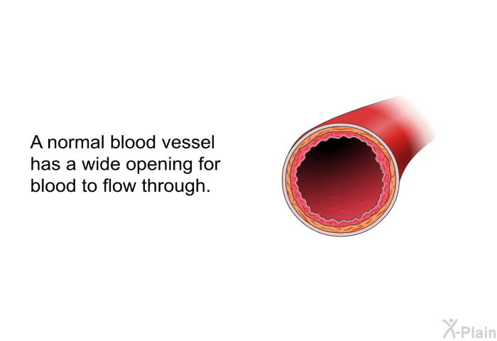 A normal blood vessel has a wide opening for blood to flow through.