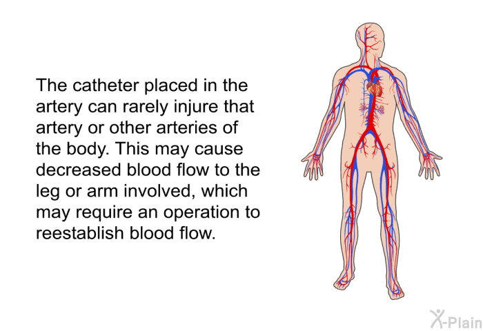 The catheter placed in the artery can rarely injure that artery or other arteries of the body. This may cause decreased blood flow to the leg or arm involved, which may require an operation to reestablish blood flow.