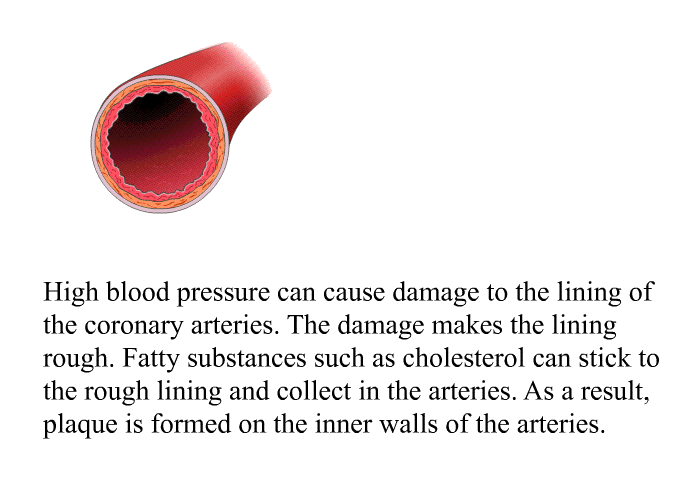 High blood pressure can cause damage to the lining of the coronary arteries. The damage makes the lining rough. Fatty substances such as cholesterol can stick to the rough lining and collect in the arteries. As a result, plaque is formed on the inner walls of the arteries.