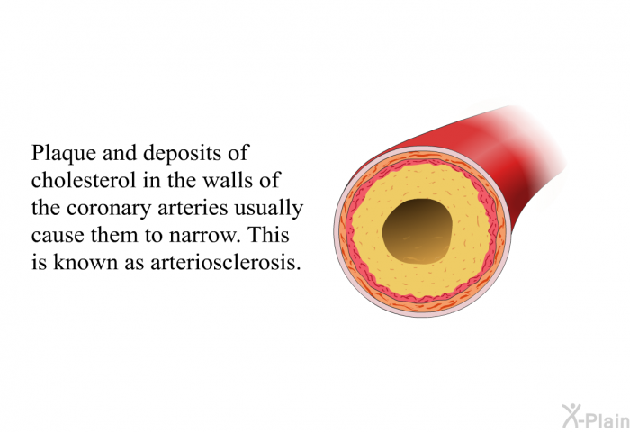 Plaque and deposits of cholesterol in the walls of the coronary arteries usually cause them to narrow. This is known as arteriosclerosis.