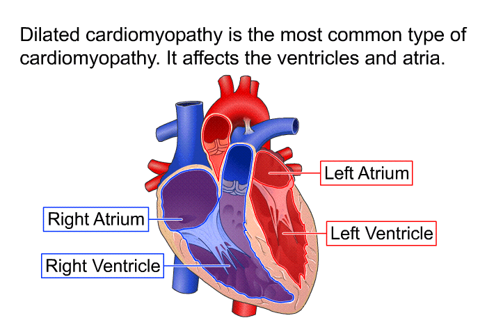 Dilated cardiomyopathy is the most common type of cardiomyopathy. It affects the ventricles and atria.