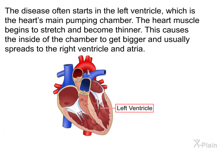 The disease often starts in the left ventricle, which is the heart's main pumping chamber. The heart muscle begins to stretch and become thinner. This causes the inside of the chamber to get bigger and usually spreads to the right ventricle and atria.