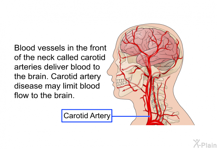 Blood vessels in the front of the neck called carotid arteries deliver blood to the brain. Carotid artery disease may limit blood flow to the brain.
