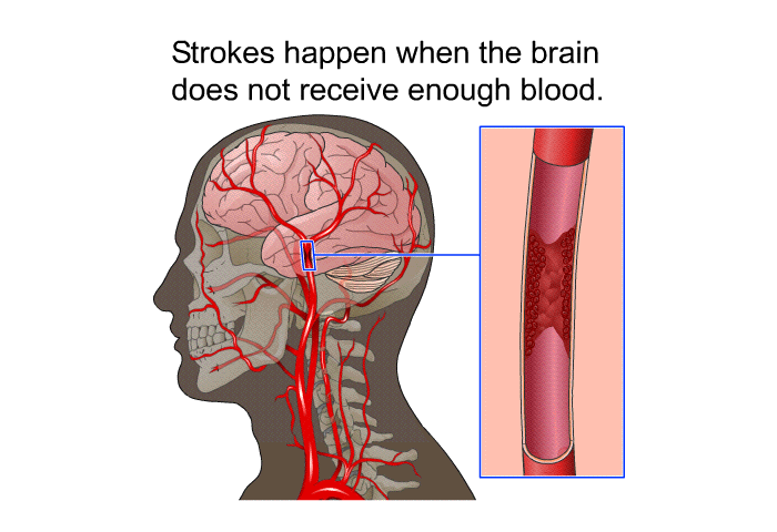 Strokes happen when the brain does not receive enough blood.