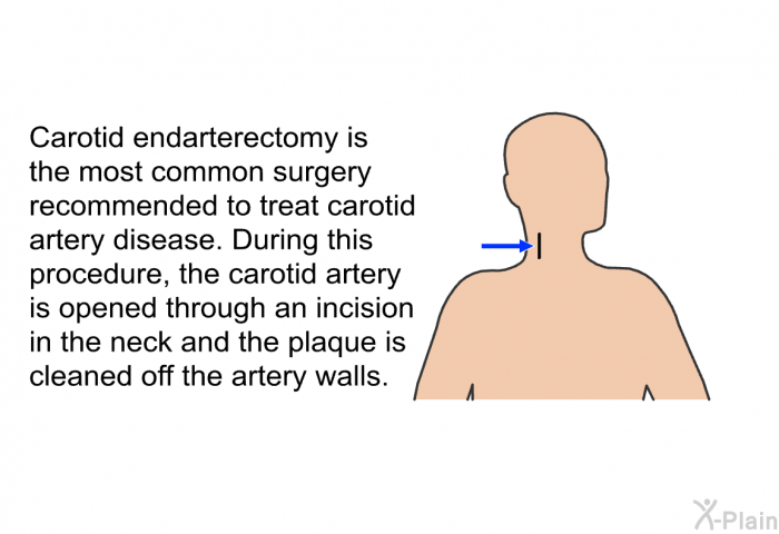 Carotid endarterectomy is the most common surgery recommended to treat carotid artery disease. During this procedure, the carotid artery is opened through an incision in the neck and the plaque is cleaned off the artery walls.