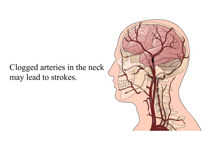 Clogged arteries in the neck may lead to strokes.