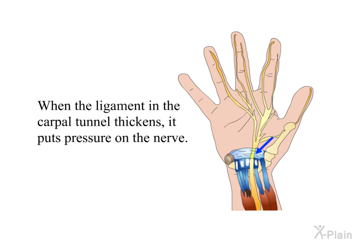 When the ligament in the carpal tunnel thickens, it puts pressure on the nerve.