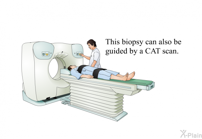 This biopsy can also be guided by a CAT scan.