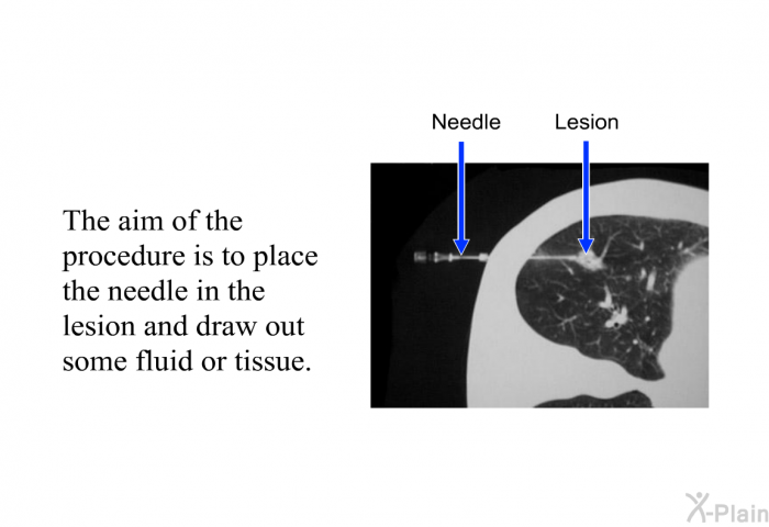 The aim of the procedure is to place the needle in the lesion and draw out some fluid or tissue.