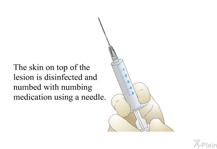 The skin on top of the lesion is disinfected and numbed with numbing medication using a needle.