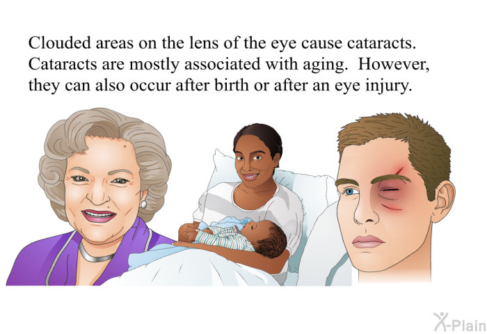 Clouded areas on the lens of the eye cause cataracts. Cataracts are mostly associated with aging. However, they can also occur after birth or after an eye injury.