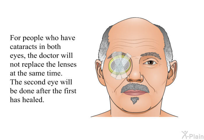 For people who have cataracts in both eyes, the doctor will not replace the lenses at the same time. The second eye will be done after the first has healed.