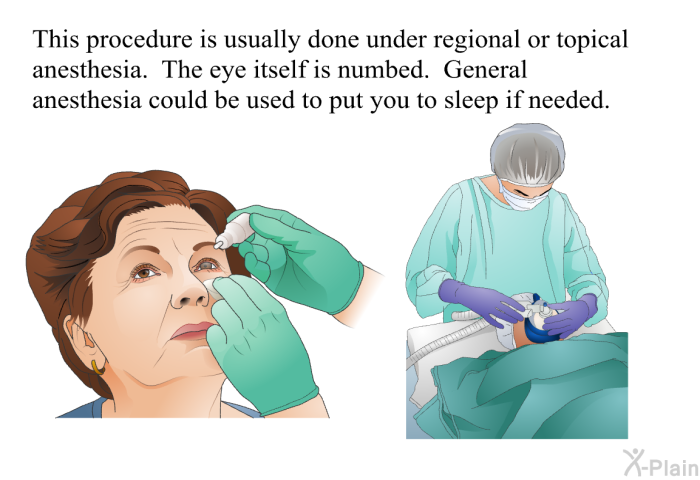 This procedure is usually done under regional, or topical, anesthesia. The eye itself is numbed. General anesthesia could be used to put you to sleep if needed.