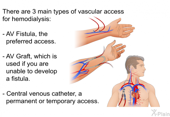 There are 3 main types of vascular access for hemodialysis:  AV Fistula, the preferred access. AV Graft, which is used if you are unable to develop a fistula. Central venous catheter, a permanent or temporary access.