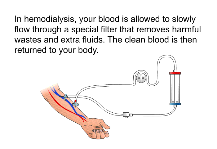 In hemodialysis, your blood is allowed to slowly flow through a special filter that removes harmful wastes and extra fluids. The clean blood is then returned to your body.