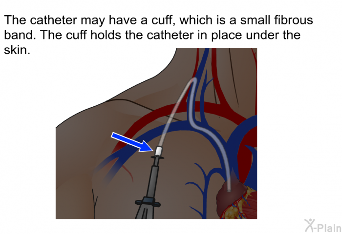 The catheter may have a cuff, which is a small fibrous band. The cuff holds the catheter in place under the skin.
