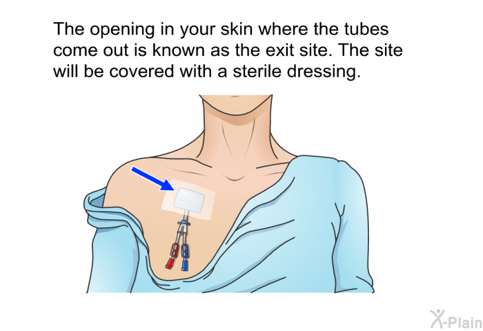 The opening in your skin where the tubes come out is known as the exit site. The site will be covered with a sterile dressing.