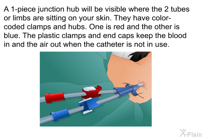 A 1-piece junction hub will be visible where the 2 tubes or limbs are sitting on your skin. They have color-coded clamps and hubs. One is red and the other is blue. The plastic clamps and end caps keep the blood in and the air out when the catheter is not in use.