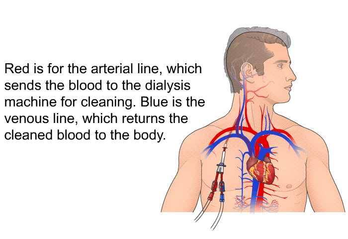 Red is for the arterial line, which sends the blood to the dialysis machine for cleaning. Blue is the venous line, which returns the cleaned blood to the body.