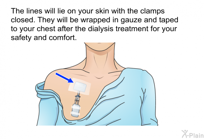 The lines will lie on your skin with the clamps closed. They will be wrapped in gauze and taped to your chest after the dialysis treatment for your safety and comfort.