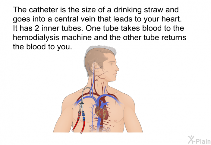 The catheter is the size of a drinking straw and goes into a central vein that leads to your heart. It has 2 inner tubes. One tube takes blood to the hemodialysis machine and the other tube returns the blood to you.
