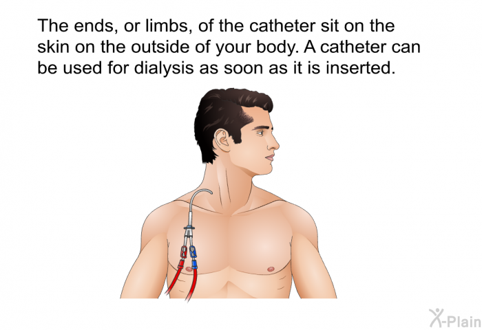 The ends, or limbs, of the catheter sit on the skin on the outside of your body. A catheter can be used for dialysis as soon as it is inserted.