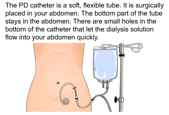 The PD catheter is a soft, flexible tube. It is surgically placed in your abdomen. The bottom part of the tube stays in the abdomen. There are small holes in the bottom of the catheter that let the dialysis solution flow into your abdomen quickly.