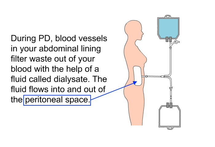 During PD, blood vessels in your abdominal lining filter waste out of your blood with the help of a fluid called dialysate. The fluid flows into and out of the peritoneal space.