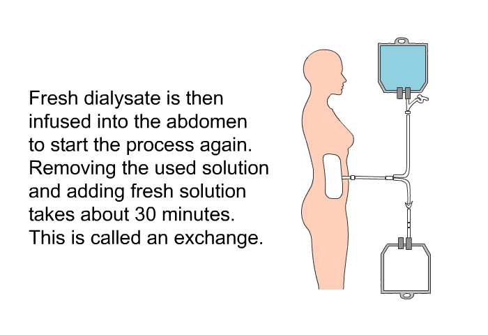 Fresh dialysate is then infused into the abdomen to start the process again. Removing the used solution and adding fresh solution takes about 30 minutes. This is called an exchange.