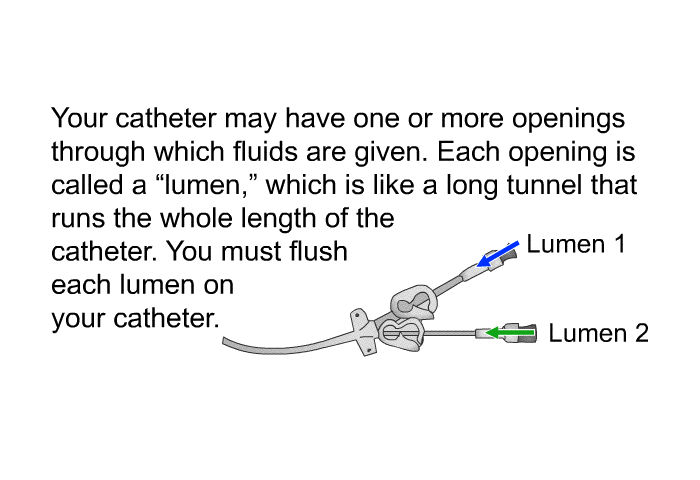 Your catheter may have one or more openings through which fluids are given. Each opening is called a “lumen,” which is like a long tunnel that runs the whole length of the catheter. You must flush each lumen on your catheter