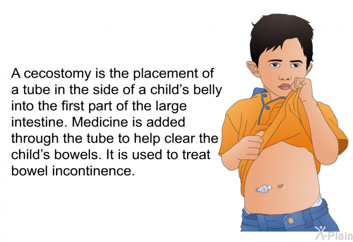 A cecostomy is the placement of a tube in the side of a child's belly into the first part of the large intestine. Medicine is added through the tube to help clear the child's bowels. It is used to treat bowel incontinence.
