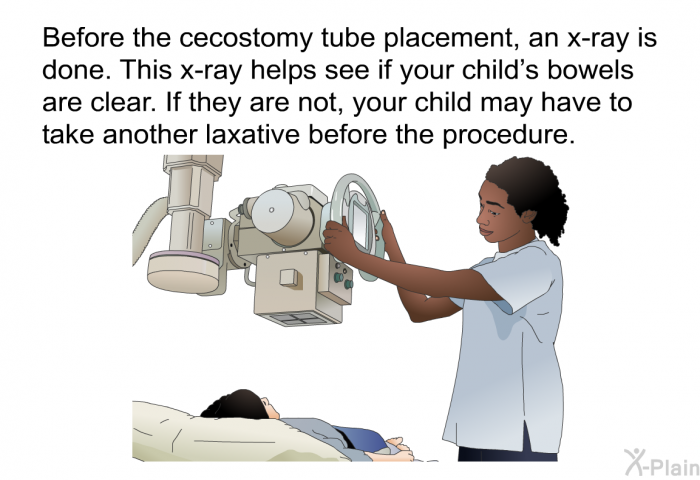 Before the cecostomy tube placement, an x-ray is done. This x-ray helps see if your child's bowels are clear. If they are not, your child may have to take another laxative before the procedure.