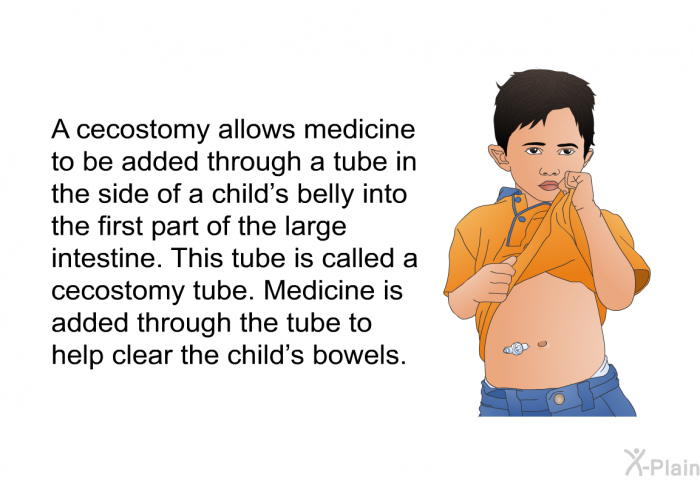 A cecostomy allows medicine to be added through a tube in the side of a child's belly into the first part of the large intestine. This tube is called a cecostomy tube. Medicine is added through the tube to help clear the child's bowels.