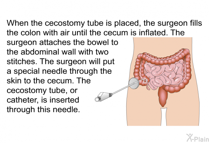 When the cecostomy tube is placed, the surgeon fills the colon with air until the cecum is inflated. The surgeon attaches the bowel to the abdominal wall with two stitches. The surgeon will put a special needle through the skin to the cecum. The cecostomy tube, or catheter, is inserted through this needle.
