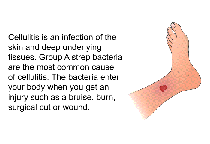 Cellulitis is an infection of the skin and deep underlying tissues. Group A strep bacteria are the most common cause of cellulitis. The bacteria enter your body when you get an injury such as a bruise, burn, surgical cut or wound.