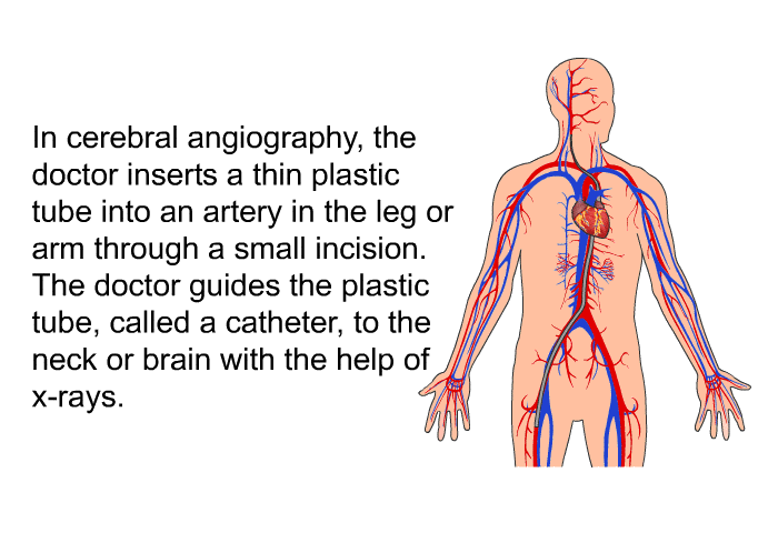 In cerebral angiography, the doctor inserts a thin plastic tube into an artery in the leg or arm through a small incision. The doctor guides the plastic tube, called a catheter, to the neck or brain with the help of x-rays.