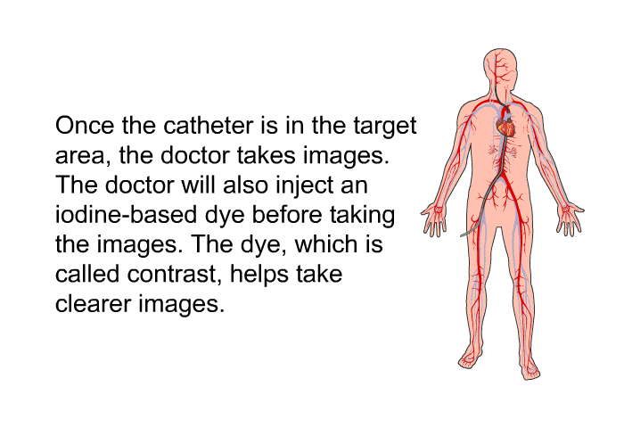 Once the catheter is in the target area, the doctor takes images. The doctor will also inject an iodine-based dye before taking the images. The dye, which is called contrast, helps take clearer images.