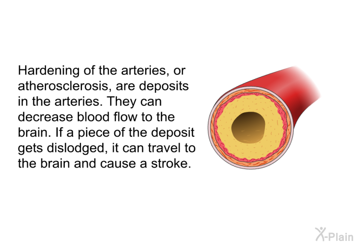 Hardening of the arteries, or atherosclerosis, are deposits in the arteries. They can decrease blood flow to the brain. If a piece of the deposit gets dislodged, it can travel to the brain and cause a stroke.