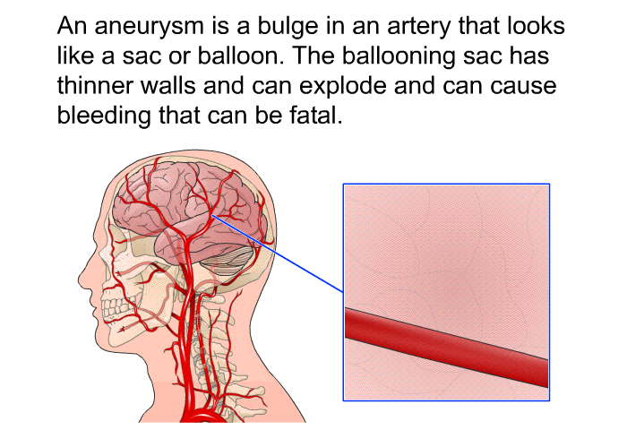 An aneurysm is a bulge in an artery that looks like a sac or balloon. The ballooning sac has thinner walls and can explode and can cause bleeding that can be fatal.
