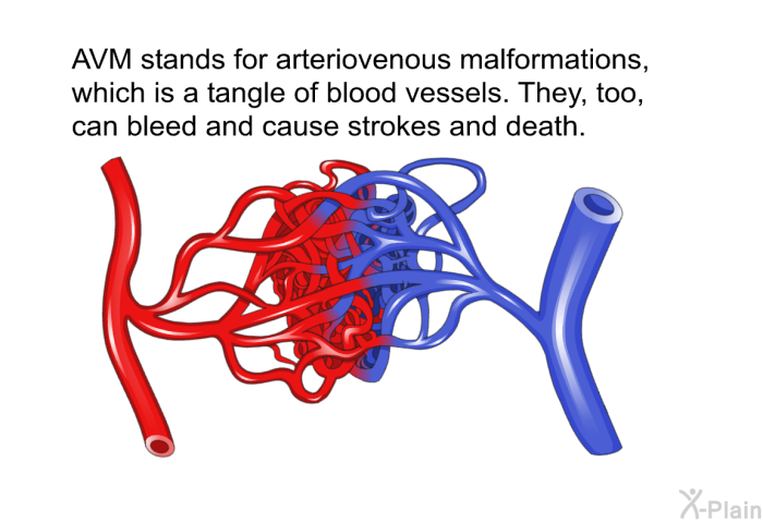 AVM stands for arteriovenous malformations, which is a tangle of blood vessels. They, too, can bleed and cause strokes and death.