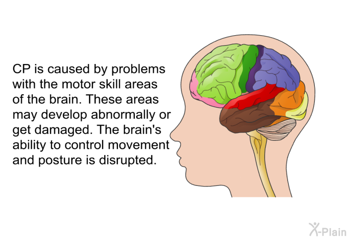 CP is caused by problems with the motor skill areas of the brain. These areas may develop abnormally or get damaged. The brain's ability to control movement and posture is disrupted.