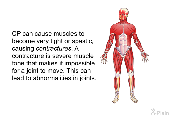 CP can cause muscles to become very tight or spastic, causing contractures. A contracture is severe muscle tone that makes it impossible for a joint to move. This can lead to abnormalities in joints.