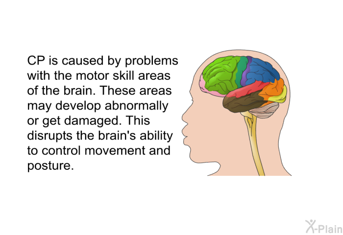 CP is caused by problems with the motor skill areas of the brain. These areas may develop abnormally or get damaged. This disrupts the brain's ability to control movement and posture.