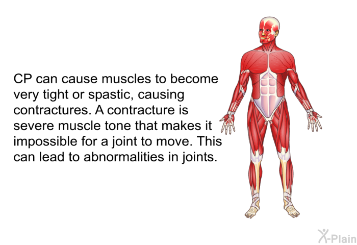 CP can cause muscles to become very tight or spastic, causing contractures. A contracture is severe muscle tone that makes it impossible for a joint to move. This can lead to abnormalities in joints.